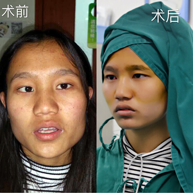 来自大凉山的18岁彝族姑娘杨里作在普瑞眼科顺利完成右眼斜视矫正手术